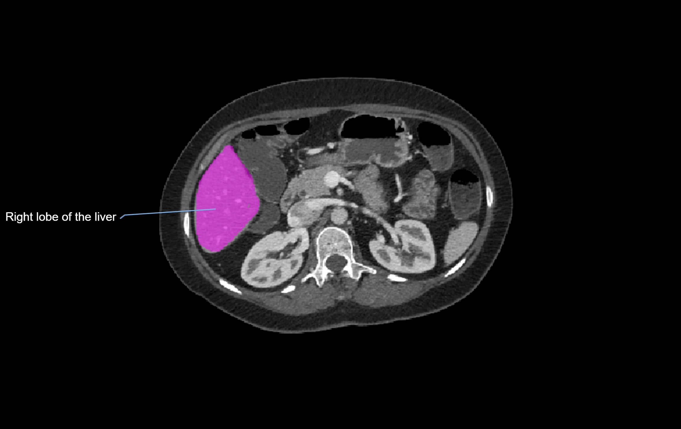 CT lliver lobes axial cross sectional anatomy labelled image -00030.webp